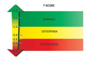 What is T Score? | T Score Bone Density