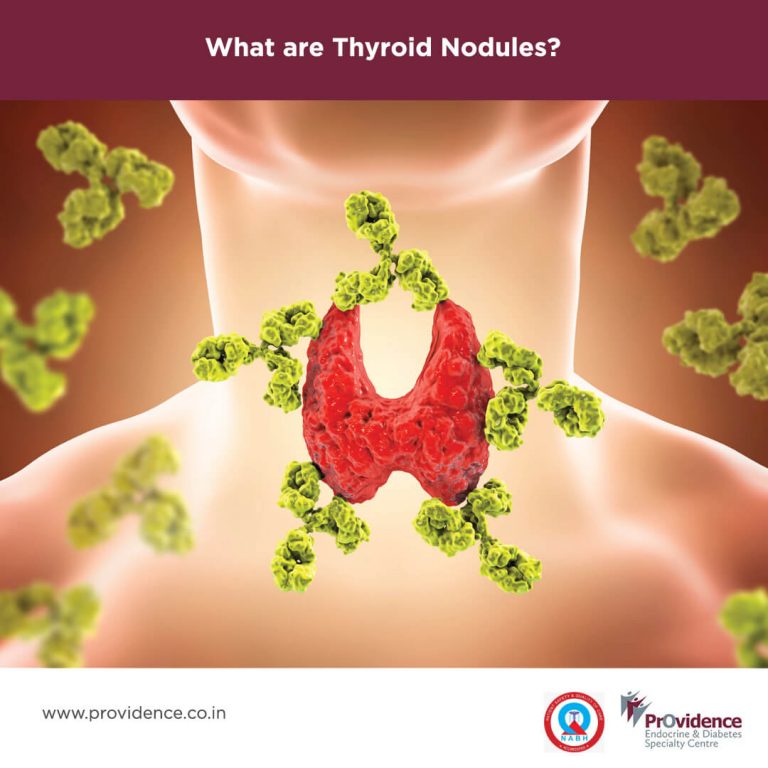 What Are Thyroid Nodules? | Thyroid Nodule Causes And Symptoms