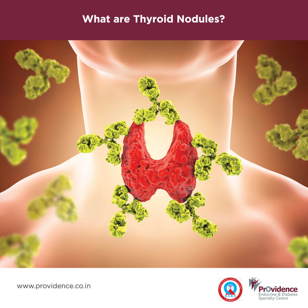 What Are Thyroid Nodules Thyroid Nodule Causes And Symptoms