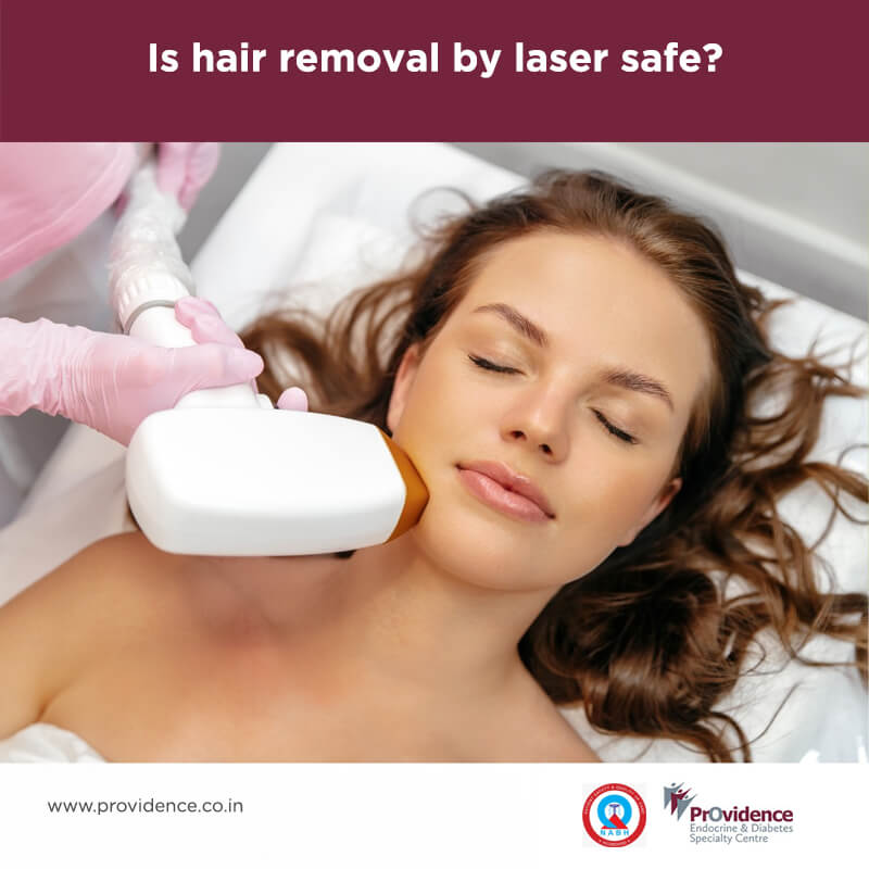 hair removal by laser