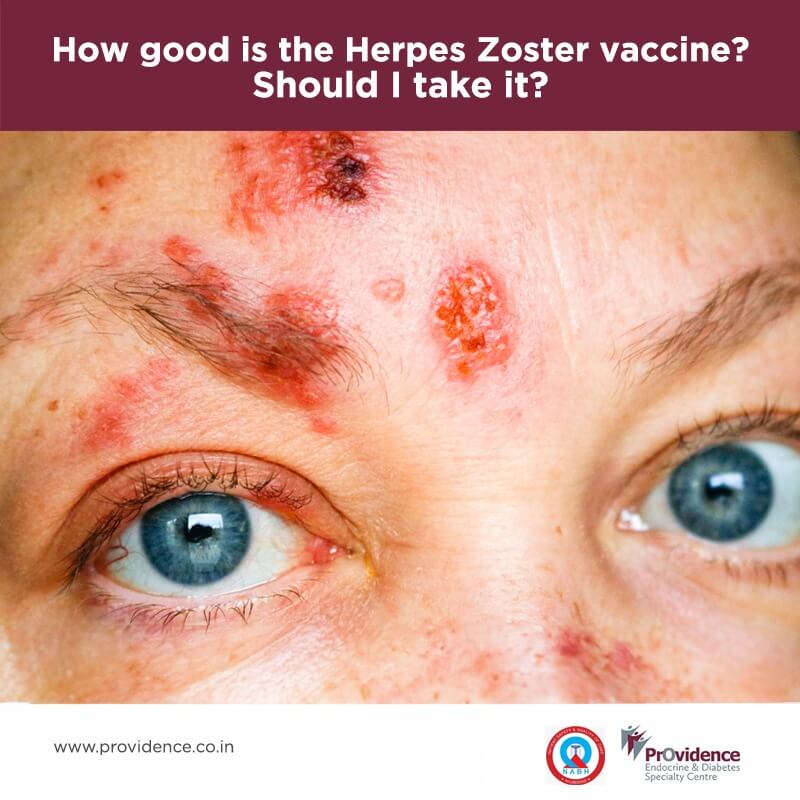 herpes zoster vaccine